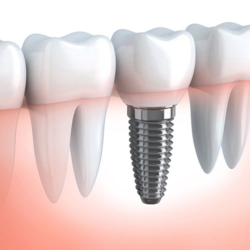 Our Dental services, My Dental Curtin Canberra, Dental Implants